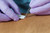 Bionix SutureOut® Suture Removal Tool (50 count)