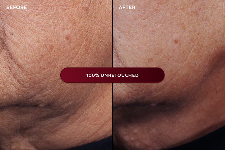 Before and after unretouched images of a person’s jawline and neck that display a visibly lifted and sculpted jawline and neck skin