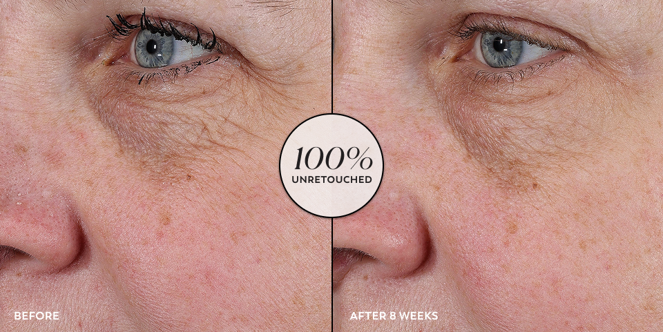 Before and after unretouched images of a person’s undereye and cheek area that displays visibly reduced looks of dark spots and discoloration