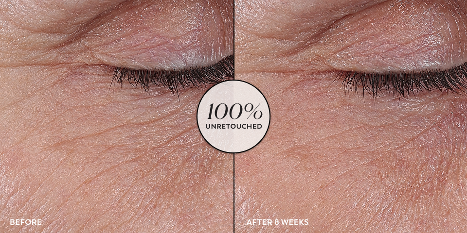 Before and after unretouched images of a person’s undereye area that displays a visibly reduced expression lines and deeper-set wrinkles