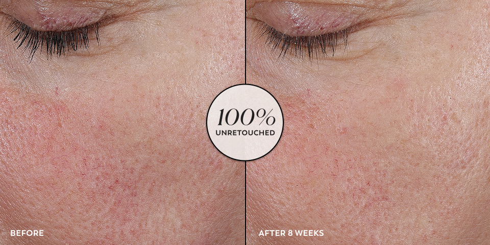 Before and after unretouched images of a person’s undereye and cheek area that displays a visibly lifted and brighter skin