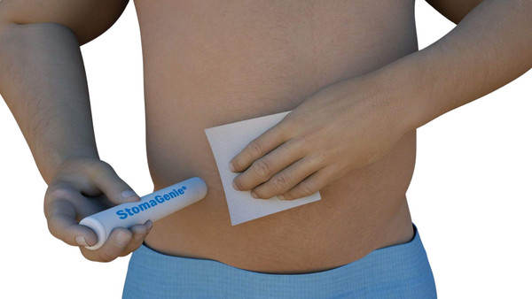 STOMAGENIE Stoma Waste Capture Device - 10-Pack (1 1/8"), Disposable Stoma Capture Cartridge for Any Type of Ileostomy, Urostomy, Colostomy Stoma Pouch Change, Skin Protection, and Leakage Prevention…