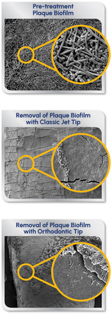 Waterpik Water Flosser Removes 99.9% of Plaque Biofilm After 3-Second Treatment