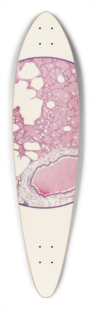 A. Kirkpatrick Maxwell - Plate I. Microscopic section of human lung from phosgene shell poisoning. Death at the nineteenth hour after gassing 39.3 inch art pintail longboard deck