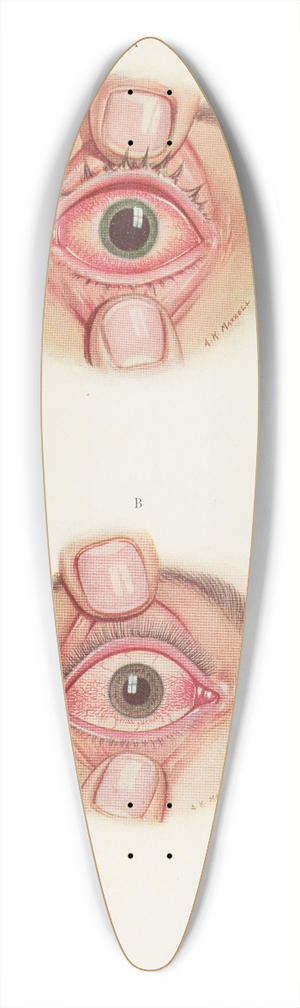 A. Kirkpatrick Maxwell - Plate XII. A. Stage of resolution after severe burning. B. Late stage of resolution 39.3 inch art pintail longboard deck