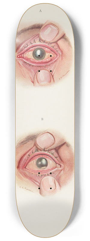 A. Kirkpatrick Maxwell - Plate XI. A. Severely burned eye in the acute stage. B. Slightly later stage of acute burning 8.25 inch art skate deck