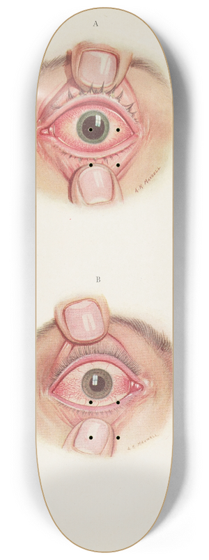A. Kirkpatrick Maxwell - Plate XII. A. Stage of resolution after severe burning. B. Late stage of resolution 8.25 inch art skate deck