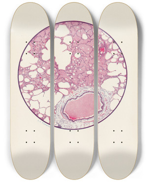 Triptych art skateboard deck of A Kirkpatrick Maxwell Plate I Microscopic Section Of Human Lung From Phosgene Shell Poisoning Death At The Nineteenth Hour After Gassing by A Kirkpatrick Maxwell (1884-1975)