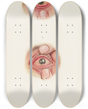 Triptych art skateboard deck of A Kirkpatrick Maxwell Plate Xi A Severely Burned Eye In The Acute Stage B Slightly Later Stage Of Acute Burning_2 by A Kirkpatrick Maxwell (1884-1975)