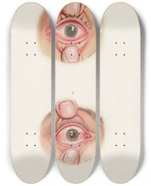 Triptych art skateboard deck of A Kirkpatrick Maxwell Plate Xii A Stage Of Resolution After Severe Burning B Late Stage Of Resolution_2 by A Kirkpatrick Maxwell (1884-1975)