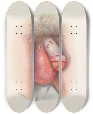 Triptych art skateboard deck of A Kirkpatrick Maxwell Plate Vii Burning Of Scrotum And Penis By Mustard Gas by A Kirkpatrick Maxwell (1884-1975)