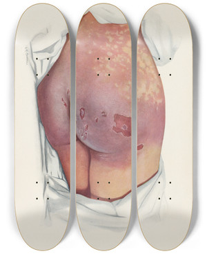 Triptych art skateboard deck of A Kirkpatrick Maxwell Plate Vi Blistering Of Buttocks By Mustard Gas by A Kirkpatrick Maxwell (1884-1975)