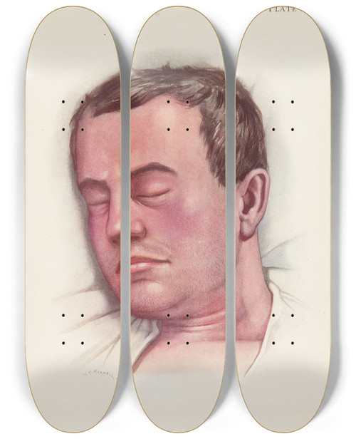 Triptych art skateboard deck of A Kirkpatrick Maxwell Plate Ii Blue Type Of Asphyxia From Phosgene Poisoning With Intense Venous Congestion by A Kirkpatrick Maxwell (1884-1975)