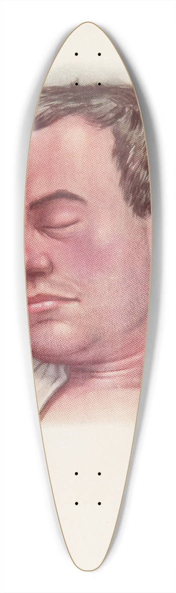 A. Kirkpatrick Maxwell - Plate II. Blue type of asphyxia from phosgene poisoning, with intense venous congestion 39.3 inch art pintail longboard deck