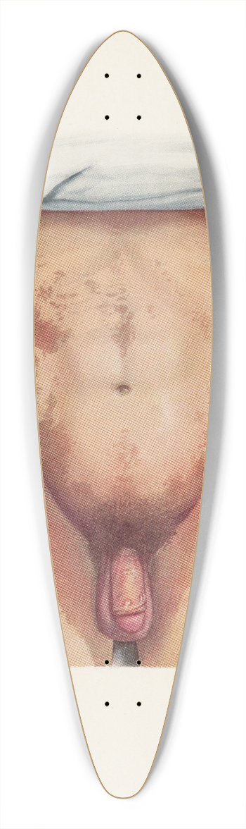 A. Kirkpatrick Maxwell - Plate VIII. Brown staining from mustard gas 39.3 inch art pintail longboard deck