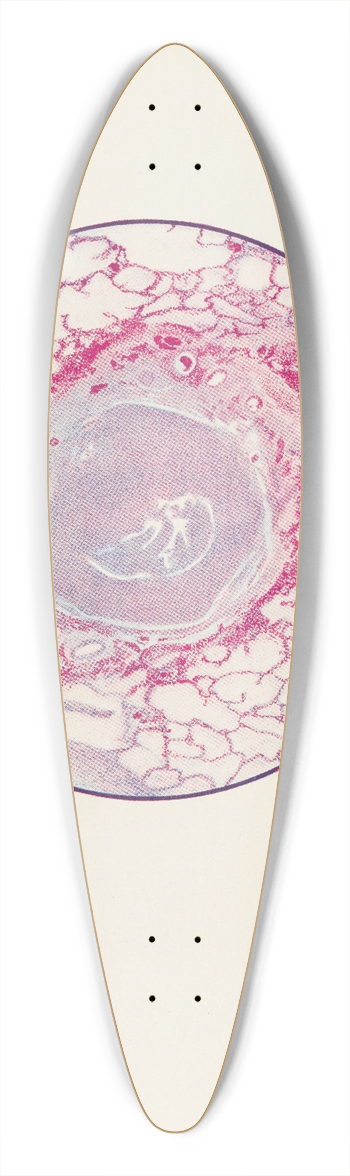 A. Kirkpatrick Maxwell - Plate X. Microscopic section of human lung from mustard gas poisoning, with death at end of second day (40 hours) 39.3 inch art pintail longboard deck