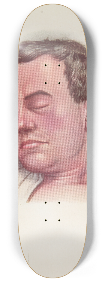 A. Kirkpatrick Maxwell - Plate II. Blue type of asphyxia from phosgene poisoning, with intense venous congestion 8.25 inch art skate deck