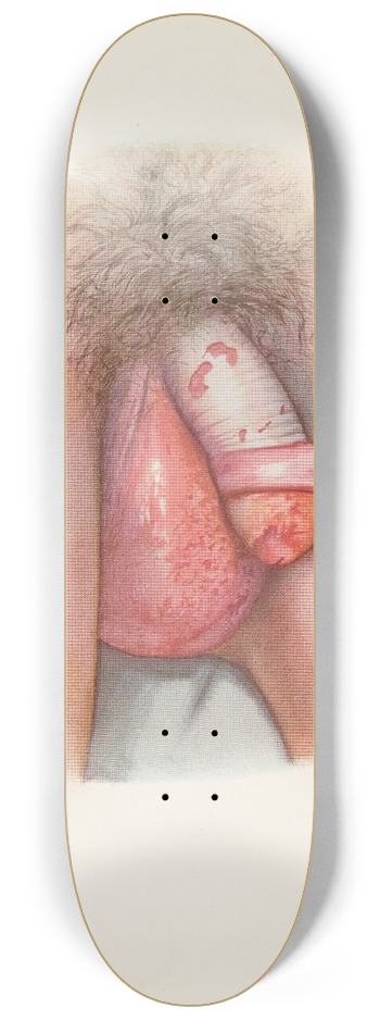 A. Kirkpatrick Maxwell - Plate VII. Burning of scrotum and penis by mustard gas 8.25 inch art skate deck