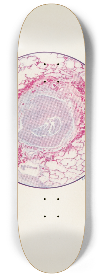 A. Kirkpatrick Maxwell - Plate X. Microscopic section of human lung from mustard gas poisoning, with death at end of second day (40 hours) 8.25 inch art skate deck