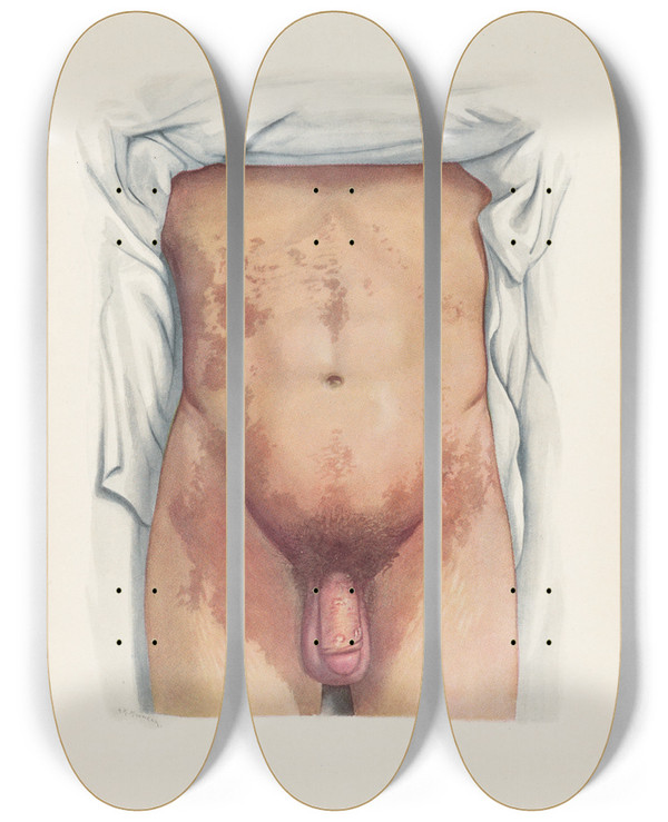 Triptych art skateboard deck of A Kirkpatrick Maxwell Plate Viii Brown Staining From Mustard Gas by A Kirkpatrick Maxwell (1884-1975)