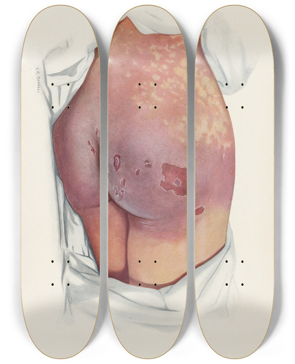 Triptych art skateboard deck of A Kirkpatrick Maxwell Plate Vi Blistering Of Buttocks By Mustard Gas by A Kirkpatrick Maxwell (1884-1975)