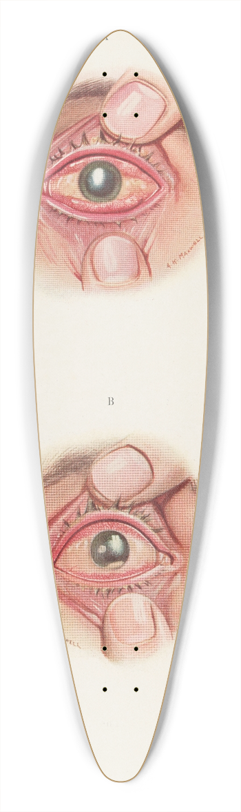 A. Kirkpatrick Maxwell - Plate XI. A. Severely burned eye in the acute stage. B. Slightly later stage of acute burning 39.3 inch art pintail longboard deck
