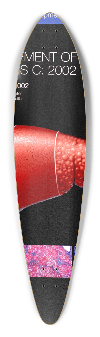 National Institutes of Health - Management of hepatitis C 39.3 inch art pintail longboard deck