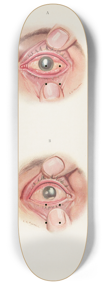 A. Kirkpatrick Maxwell - Plate XI. A. Severely burned eye in the acute stage. B. Slightly later stage of acute burning 8.25 inch art skate deck