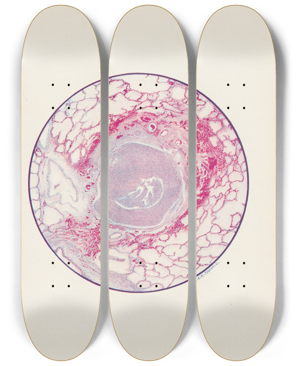 Triptych art skateboard deck of A Kirkpatrick Maxwell Plate X Microscopic Section Of Human Lung From Mustard Gas Poisoning With Death At End Of Second Day 40 Hours by A Kirkpatrick Maxwell (1884-1975)