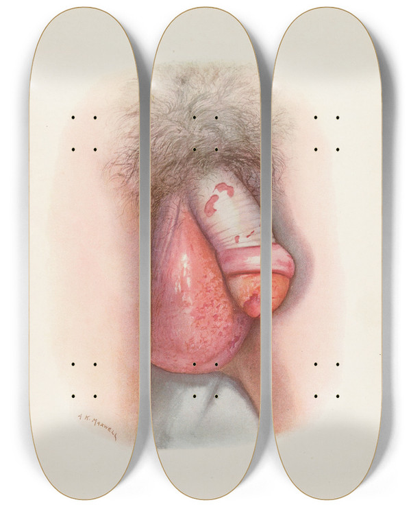 Triptych art skateboard deck of A Kirkpatrick Maxwell Plate Vii Burning Of Scrotum And Penis By Mustard Gas by A Kirkpatrick Maxwell (1884-1975)