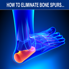 How and why bone spurs form and how to eliminate them naturally without invasive treatments