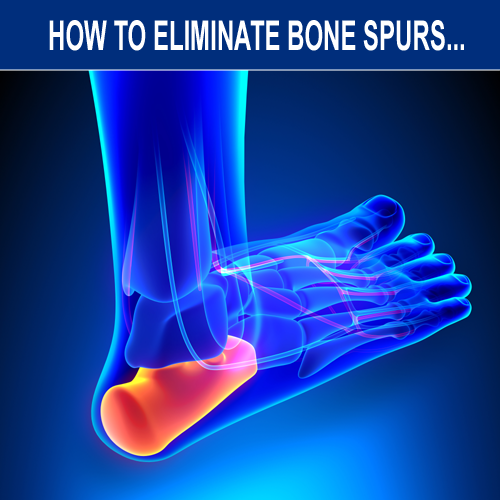 How And Why Bone Spurs Form And How To Eliminate Them Naturally Without Invasive Treatments 4746