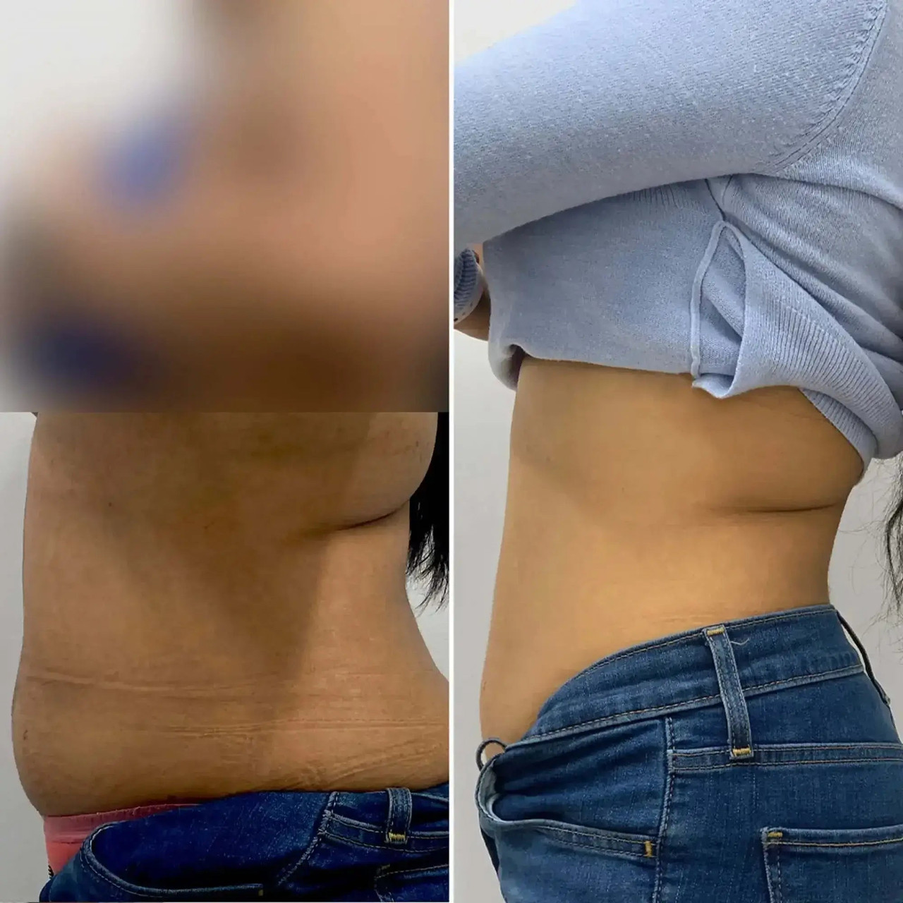 AbFix: EmSculpt Neo - BeautyFixMedSpa
