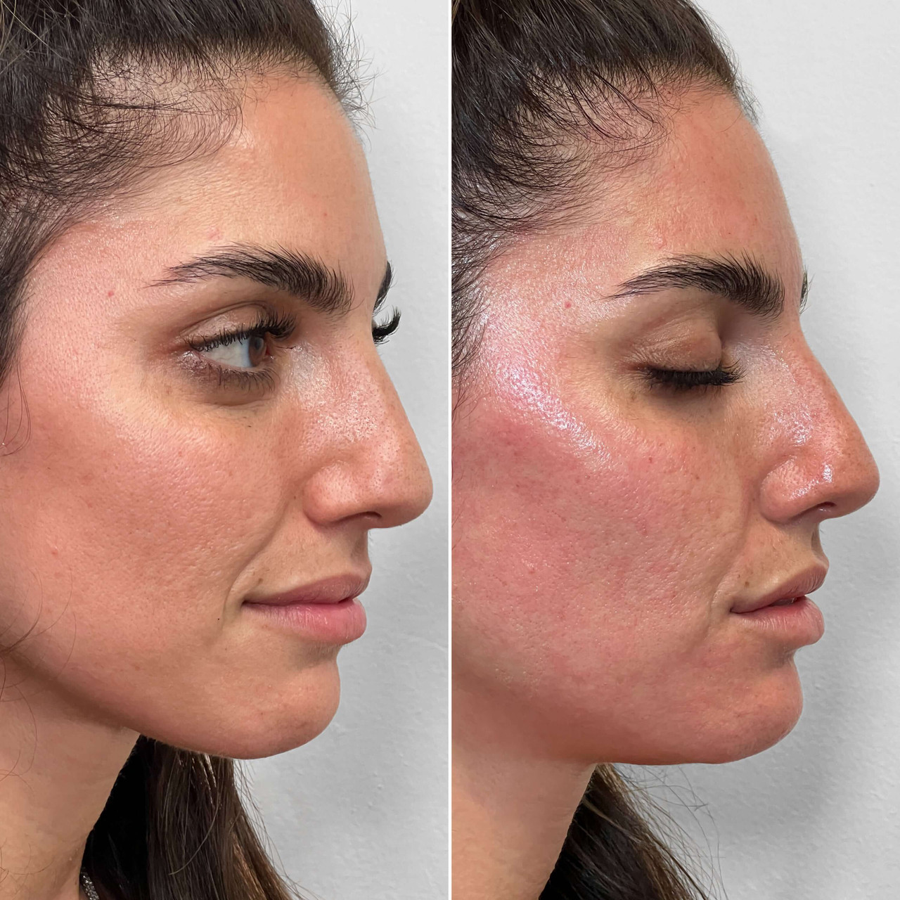 FaceFix: Salmon DNA - BeautyFixMedSpa