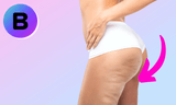 Reduce Cellulite With Medspa Treatments