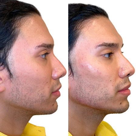 JawlineFix: Filler