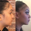 ChinFix: Kybella