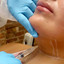 ChinFix: Kybella