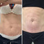 BodyFix: Morpheus8