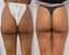 BootyFix: DSE Peel + Microneedling