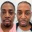 CheekFix: Buccal Fat Reduction