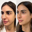 CheekFix: Buccal Fat Reduction