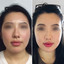 CheekFix: Buccal Fat Reduction