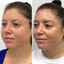 CheekFix: Buccal Fat Reduction