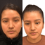 CheekFix: Buccal Fat Reduction