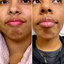 ChinFix: Botox