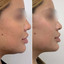 ChinFix: CoolSculpting