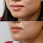 ChinFix: Filler
