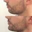 ChinFix: Filler