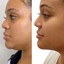 ChinFix: Liposuction